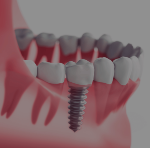 Implante dentário